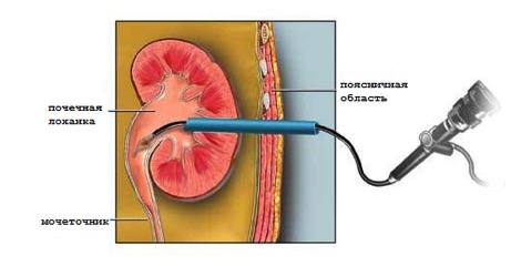 Percutaneous (percutaneous) removal of kidney stones
