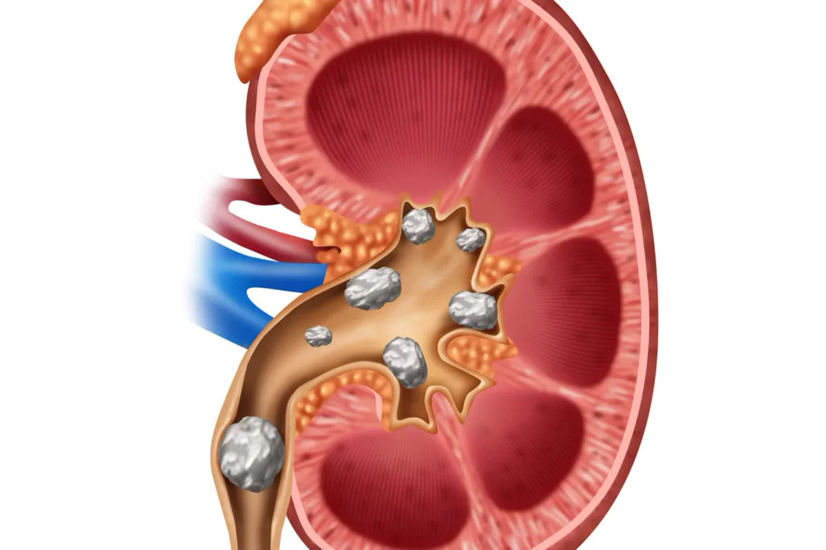 Treatment of ureteral stenting 