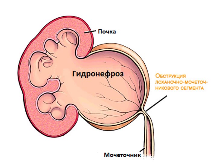 Narrowing of the ureteropelvic segment
