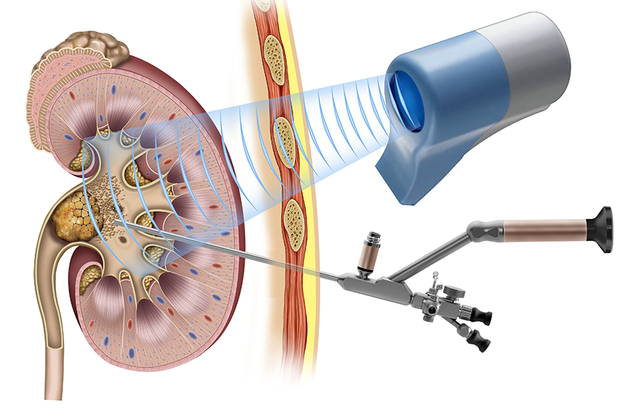 Laser removal of kidney stones