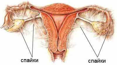 Laparoscopic surgery of fibroids. Diagnostics. Care. Prevention