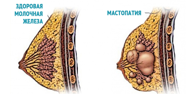 Differential diagnosis and treatment of mastopathy
