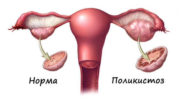 Polycystic ovaries. Diagnosis and treatment 