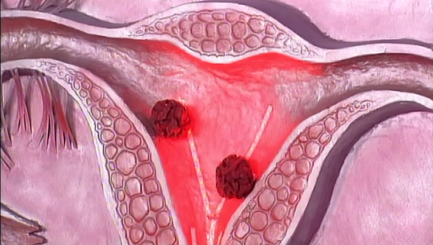Рак шейки матки, матки и яичников. Симптомы, диагностика и лечение 