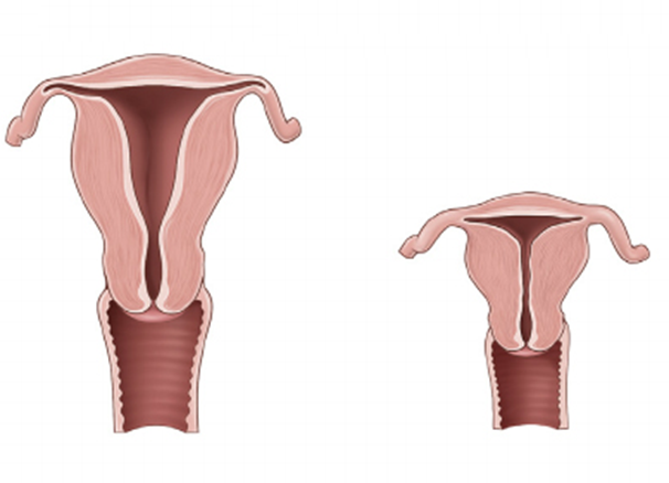 Гипоплазия матки. Причины, диагностика и лечение болезни 