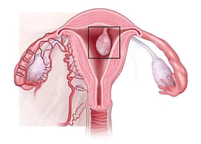 Modern treatment of endometrial polyp i