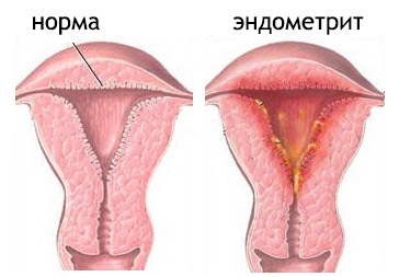 Diagnosis and treatment of endometritis 