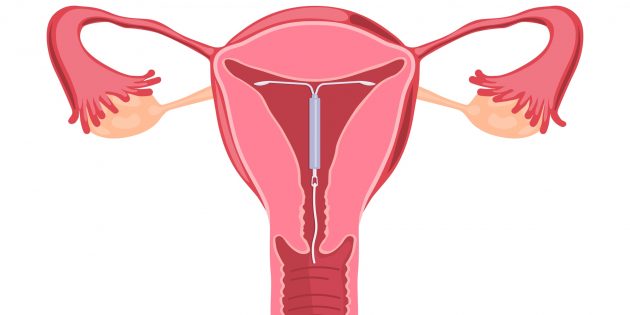 Ingrown IUD into the wall of the uterus, treatment and diagnosis