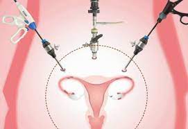 Laparoscopic hysterectomy