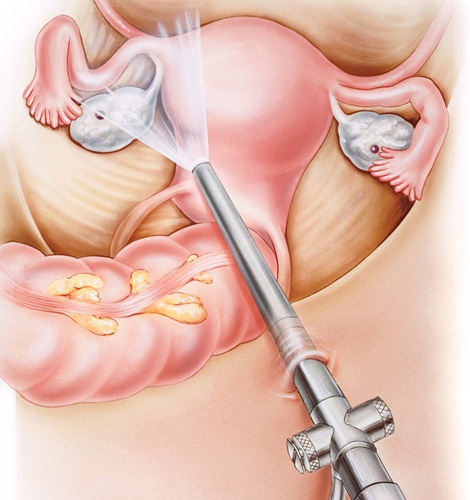 Restoration of patency of the fallopian tubes