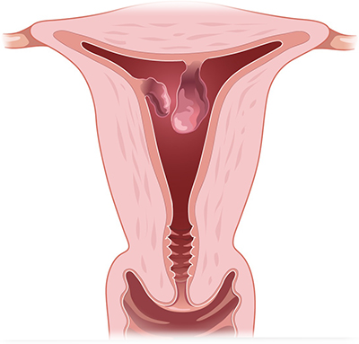 Endometrial polyps