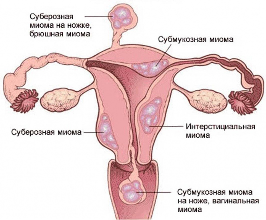 Nascent uterine fibroids